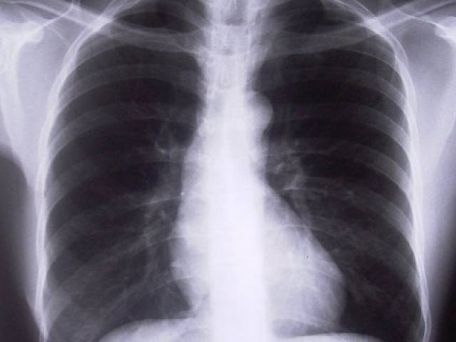 24. marts – Pasaules Tuberkulozes diena